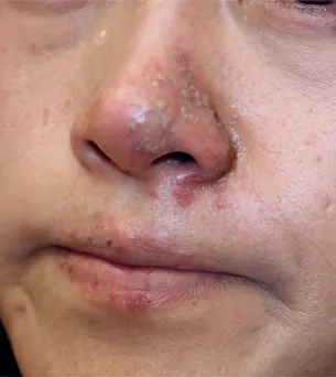 Reactivación herpética florida tras un relleno: vesículas agrupadas y pústulas con costra sobre dorso nasal, alas nasales, columela, labio superior cutáneo y bermellón, con eritema perilesional. La extensión más allá del punto de inyección y el respeto relativo de la línea media son lo que distingue esta lámina de una infección bacteriana de la puerta de entrada. Garg 2021, figura 4-10.